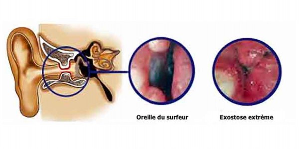 L'oreille du surfeur ou exostose